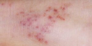 meningitis-rash-1296×728-body-750×375