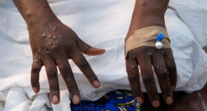 Ghana-Reports-First-Case-Of-Mpox-This-Year-Strain-Yet-To-Be-Identified-2162213534-700×375 (1)